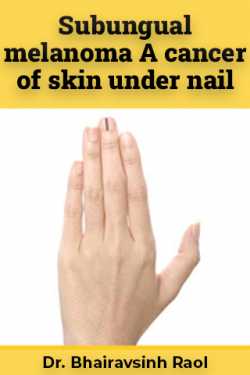 Subungual melanoma A cancer of skin under nail by Dr. Bhairavsinh Raol in English