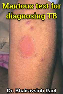 Mantoux test for diagnosing TB