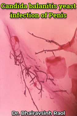 Candida balanitis yeast infection of Penis
