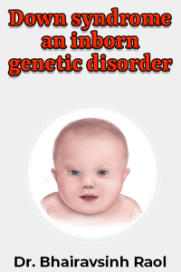 Down syndrome an inborn genetic disorder