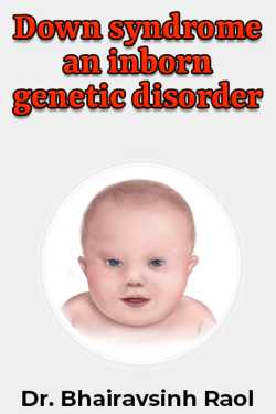 Down syndrome an inborn genetic disorder by Dr. Bhairavsinh Raol in English